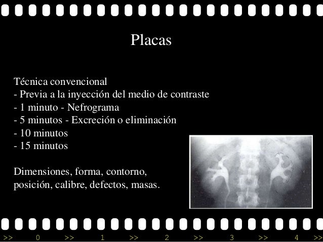 indicaciones urografia excretora